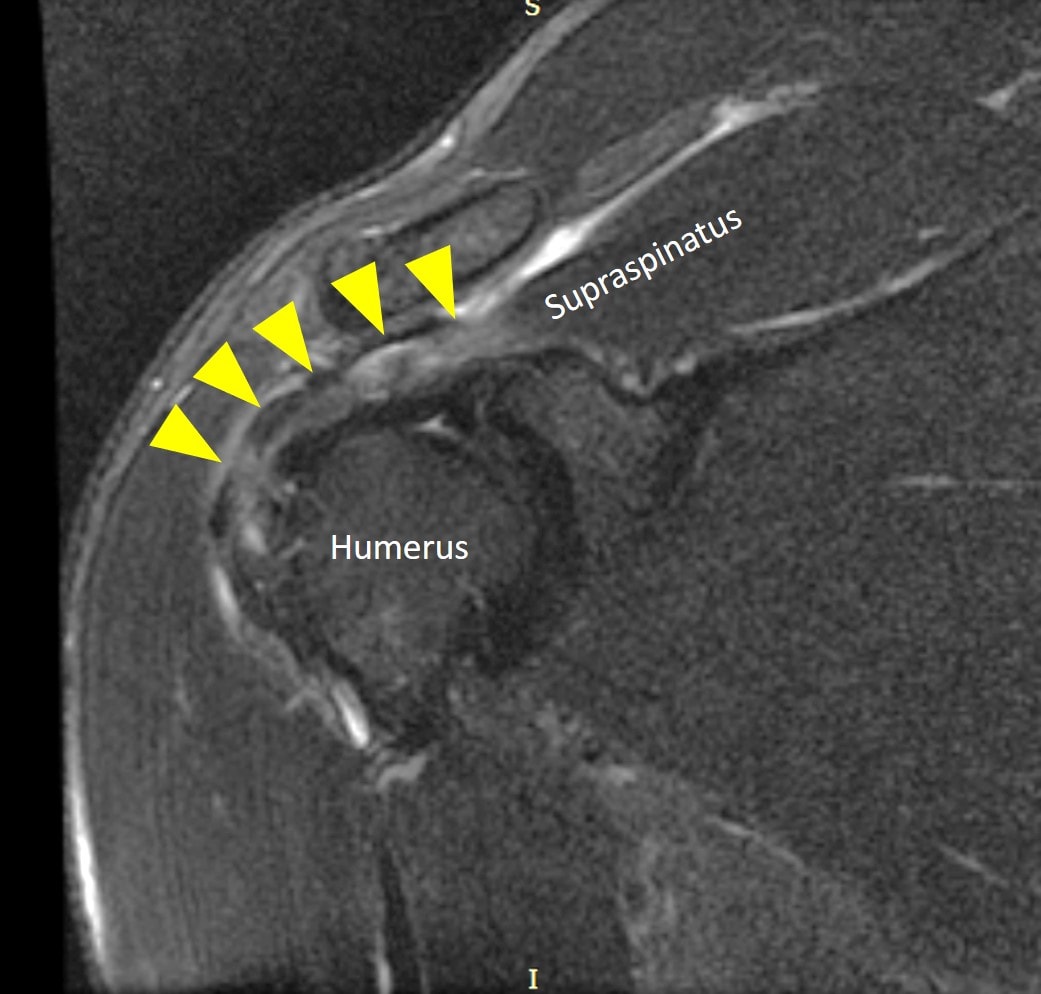When Not to Have Rotator Cuff Surgery